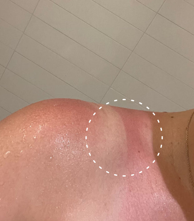 Image of person with a sunburn on their shoulder
